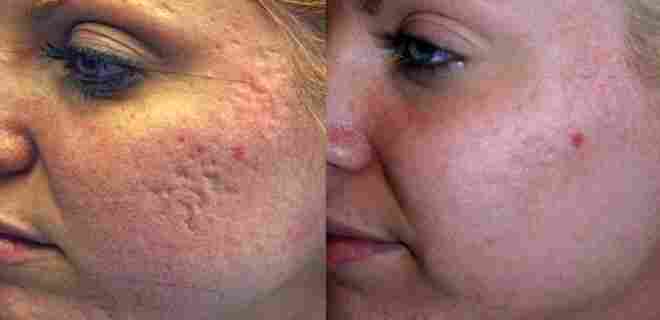 Akne izlerinden nasıl